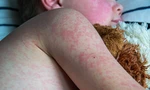 Những sai lầm nguy hiểm của cha mẹ khi chăm sóc con bị sởi khiến bệnh nặng thêm