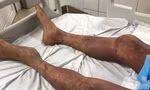 Một người đàn ông ở Thanh Hóa tử vong do nhiễm khuẩn liên cầu lợn