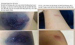 Sinh viên Ký túc xá Khu B, ĐHQG TP. HCM lo lắng vì bị kiến ba khoang ‘tấn công’
