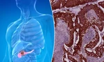 Tỷ lệ tử vong vì ung thư tuyến tụy tăng nhanh ở phụ nữ dưới 55 tuổi