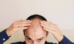 Tại sao đàn ông hay bị hói ở đỉnh đầu và cách chữa trị 