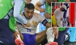 Mbappe gãy mũi, nguy cơ lỡ đại chiến với tuyển Hà Lan