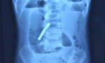 Bé trai 2 tuổi thủng ruột vì món đồ chơi nhiều trẻ em mê mẩn