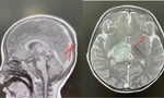 Bé trai hơn 2 tuổi đột quỵ vì bệnh lý hiếm gặp