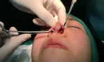 Nâng mũi trong khách sạn, 2 phụ nữ bị tai biến và trộm cắp tài sản