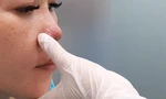 Mũi miệng bầm tím, mặt biến dạng sau tiêm chất làm đầy tại spa