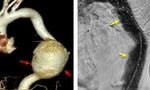 Cứu bệnh nhân nước ngoài bị vỡ túi phình động mạch chủ khổng lồ