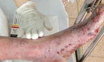 Bệnh nhân bong da toàn thân vì loại vi khuẩn nguy hiểm kháng thuốc