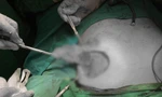 Tan nát 'vòng 1' sau nâng ngực làm đẹp