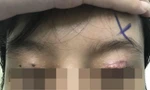 Thủng mắt, vỡ thủy tinh thể sau cắt mí làm đẹp