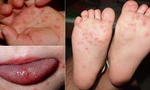 Cuối năm trẻ mắc bệnh tay chân miệng tăng