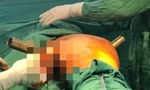 Nam thanh niên bị ống sắt đâm xuyên cơ thể sau vụ tai nạn kinh hoàng