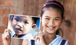 Phẫu thuật miễn phí dị tật khe hở môi, hàm ếch cho bệnh nhân