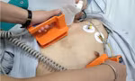 Hơn 30 lần sốc điện cứu bệnh nhân thoát khỏi 'cơn bão điện học'