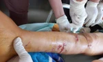 Hơn một nghìn người bị chó cắn khi đi chúc Tết