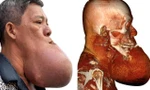 Cứu bệnh nhân bị 'nổ tung' khối u khổng lồ