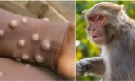 TPHCM khẩn cấp ứng phó bệnh đậu mùa khỉ