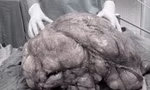 Người đàn ông ở TPHCM mang 'bụng bầu' nặng gần 18kg