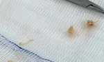 Xương lươn đâm xuyên thực quản khiến bé gái 10 tháng tuổi nguy kịch