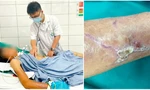 Cứng hàm, suy hô hấp vì vết xước nhỏ, cảnh báo 'đặc biệt' từ hai ca uốn ván nặng