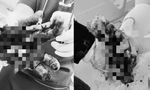 Nát hai bàn tay, đa chấn thương do tai nạn pháo nổ