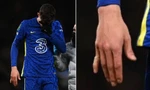 Ngôi sao Chelsea gãy ngón tay sau khi ghi bàn, cắn răng thi đấu hết hiệp 1