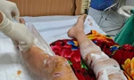 Lào Cai: Nam sinh bị chó thả rông cắn gây thương tích nặng