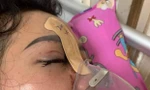 Mù mắt vì tiêm filler nâng mũi từ spa biết trên Facebook