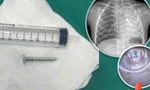 Gắp đinh vít sắc nhọn trong phổi, cứu sống bé 4 tuổi đã ngừng thở 