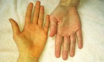 Bất kỳ ai cũng có thể mắc bệnh viêm gan B nếu không có biện pháp phòng ngừa