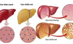 Hình ảnh minh họa gan nhiễm mỡ. 