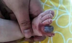 Ngón chân chuyển sang màu đen do bị sợi tóc quấn chặt. Ảnh: Daily Mail.