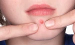 Nữ sinh 15 tuổi ở Hà Nội tử vong sau khi nặn mụn, bôi thuốc không rõ nguồn gốc