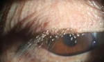 Rận ký sinh và đẻ trứng chi chít trên mi mắt người phụ nữ