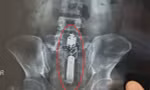Sextoy kẹt trong trực tràng nam thanh niên.