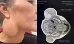 Loại bỏ thành công khối u tuyến nước bọt khổng lồ đeo đẳng người phụ nữ 60 tuổi