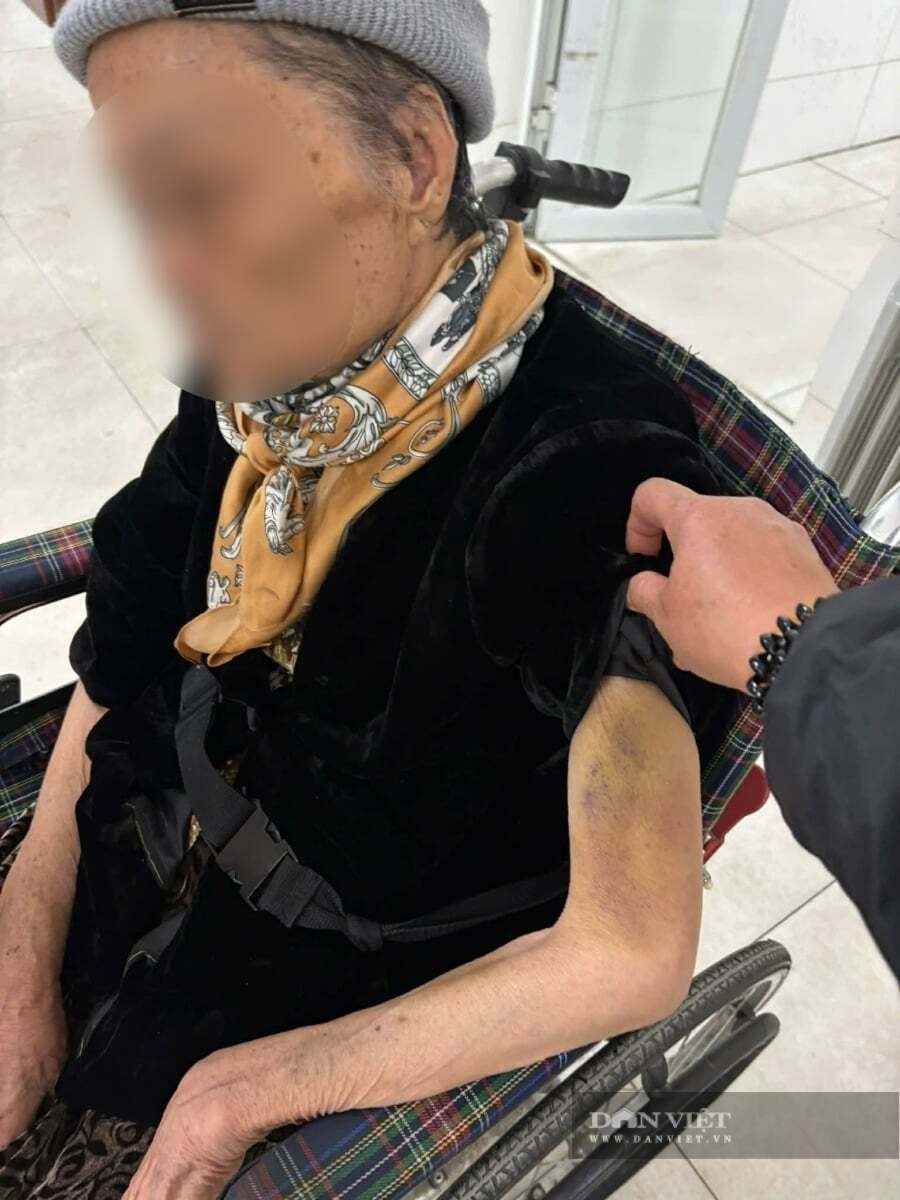 Hình ảnh cụ N. thâm tím tay, nhiều bộ phận cơ thể. Ảnh: Gia Khiêm
