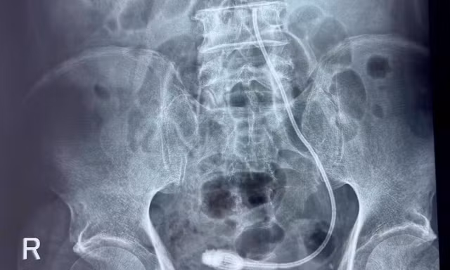Để quên ống nhựa trong đường tiết niệu của cụ ông 9 năm