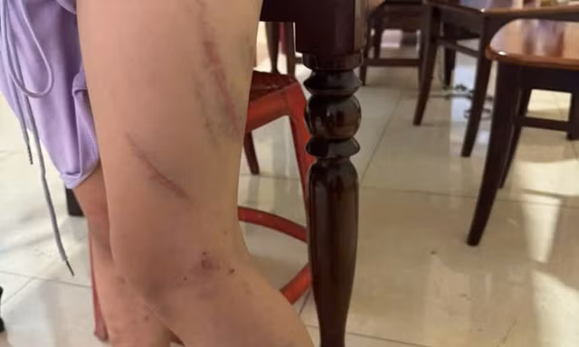 Bé gái 9 tuổi chi chít vết bầm trên cơ thể, nghi bị mẹ bạo hành