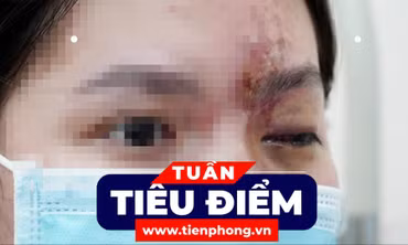 TIÊU ĐIỂM: Sức khỏe cô gái bị mù mắt vì tiêm filler môi, cằm, mũi ở tiệm cắt tóc; Con số của tuần: 292