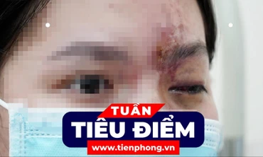 TIÊU ĐIỂM: Sức khỏe cô gái bị mù mắt vì tiêm filler môi, cằm, mũi ở tiệm cắt tóc; Con số của tuần: 292