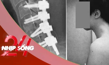 NHỊP SỐNG 24: Thanh niên mắc ‘hội chứng rụng đầu' vì dùng điện thoại