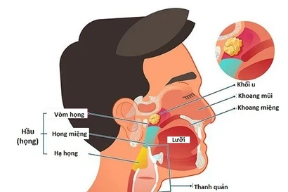 Người đàn ông mắc đồng thời hai ung thư nguy hiểm