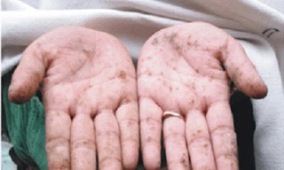 Biểu hiện của nhiễm độc asen