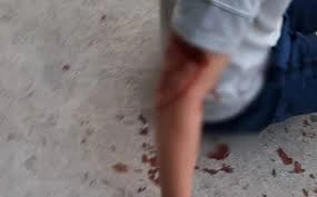 Xác minh vụ chó cắn du khách nước ngoài nhập viện tại Nha Trang