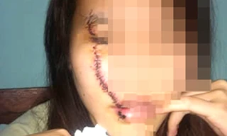 Cô gái bị nữ sinh 16 tuổi rạch mặt giữa đường