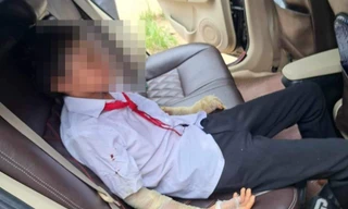 Nổ bóng bay ngày khai giảng, 10 học sinh bị bỏng