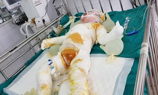 Bé Nhật Linh bị bỏng nặng toàn thân