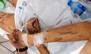 Võ Duy Nghiêm bị tạt axit, cắt gân chân khi về quê ăn tết