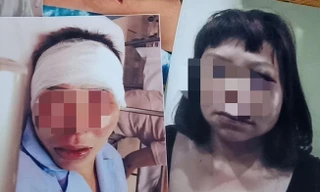 Chị Hạnh bị chồng bạo hành dã man